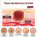 Adeus Verrugas: Creme Removedor de Ação Rápida Para Uma Pele Lisa e Sem Marcas |COMPRE 1 LEVE 2|