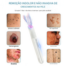 O Fim da Vergonha: Remova Sinais, Verrugas e Manchas Escuras com um Único Clique — Antes que Elas se Multipliquem.